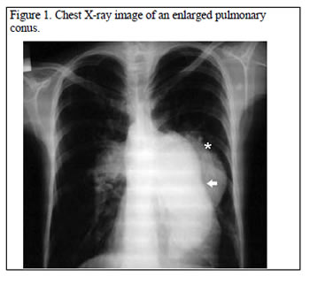 Pulmonary Artery Aneurysm