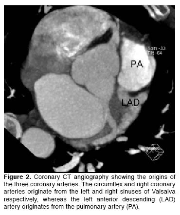 aortocoronary bypass