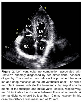 ventricular noncompaction