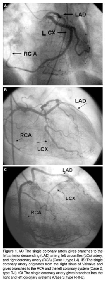 Single Coronary Artery