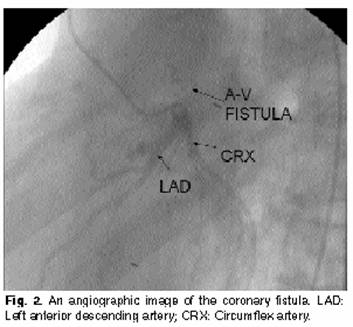Coronary Fistula