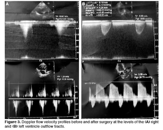 lvot gradient